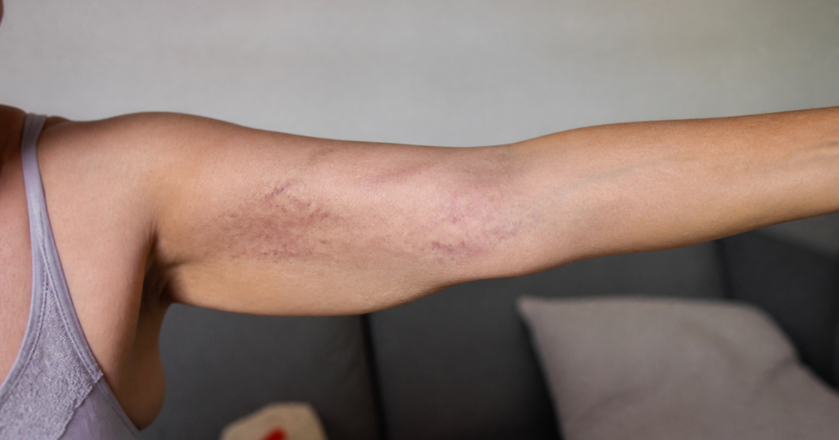 Bras etendu montrant des taches violacees sur la peau