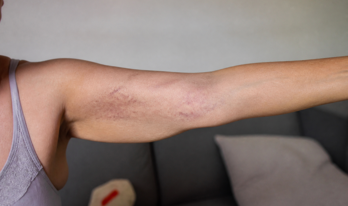 Bras etendu montrant des taches violacees sur la peau