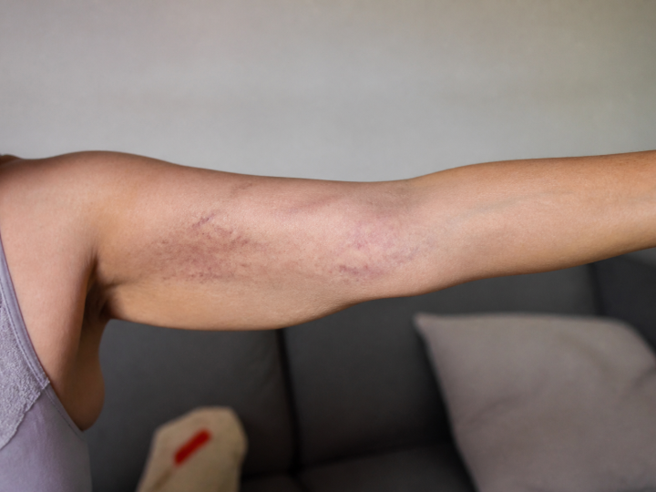 Bras etendu montrant des taches violacees sur la peau