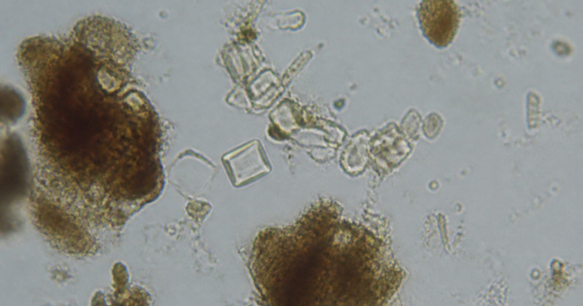Microscope view showing crystalline stones in fecal sample.