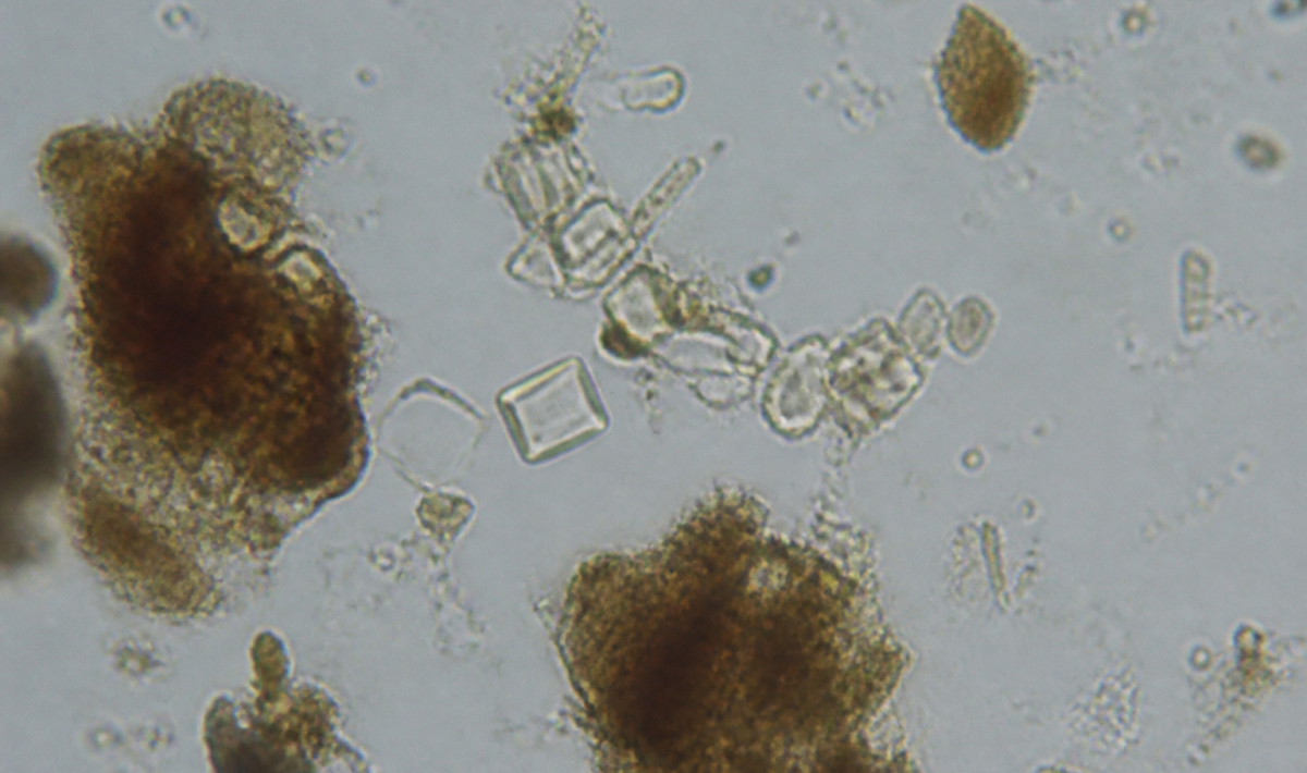 Microscope view showing crystalline stones in fecal sample.