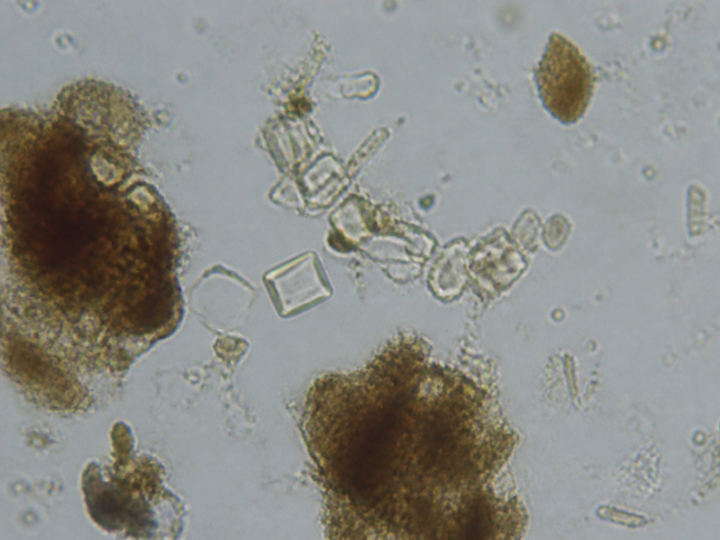 Microscope view showing crystalline stones in fecal sample.