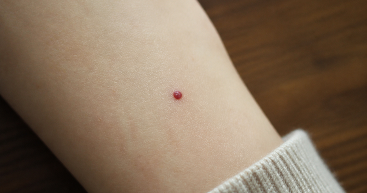Peau claire avec petite tache rouge circulaire surélevée