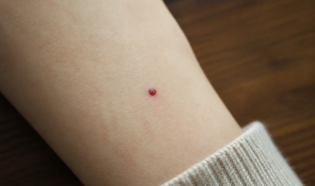 Peau claire avec petite tache rouge circulaire surélevée