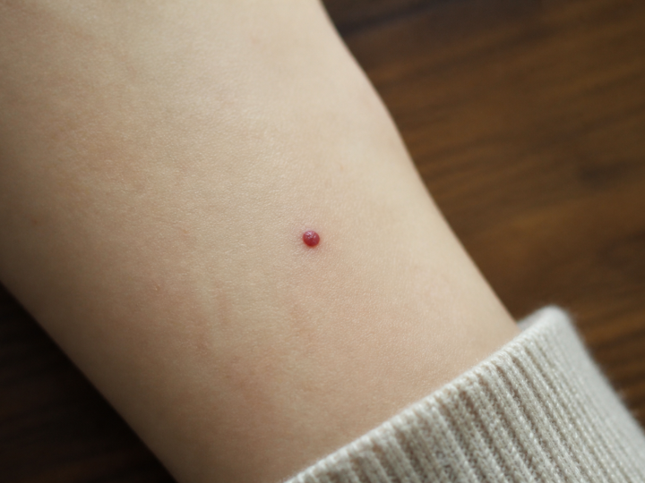 Peau claire avec petite tache rouge circulaire surélevée
