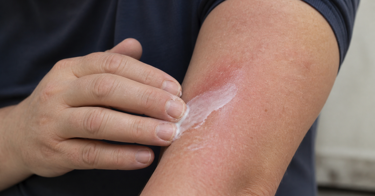 Person applying cream to red swollen arm skin.