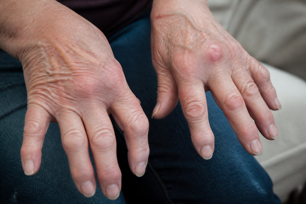 Mains montrant nodules arthrose doigts articulations enflees