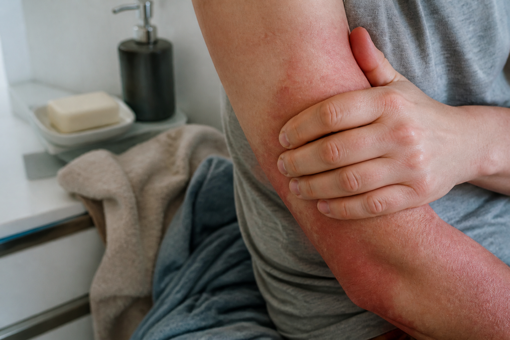 Peau irritee avec savon, tissus synthetiques et acariens visibles