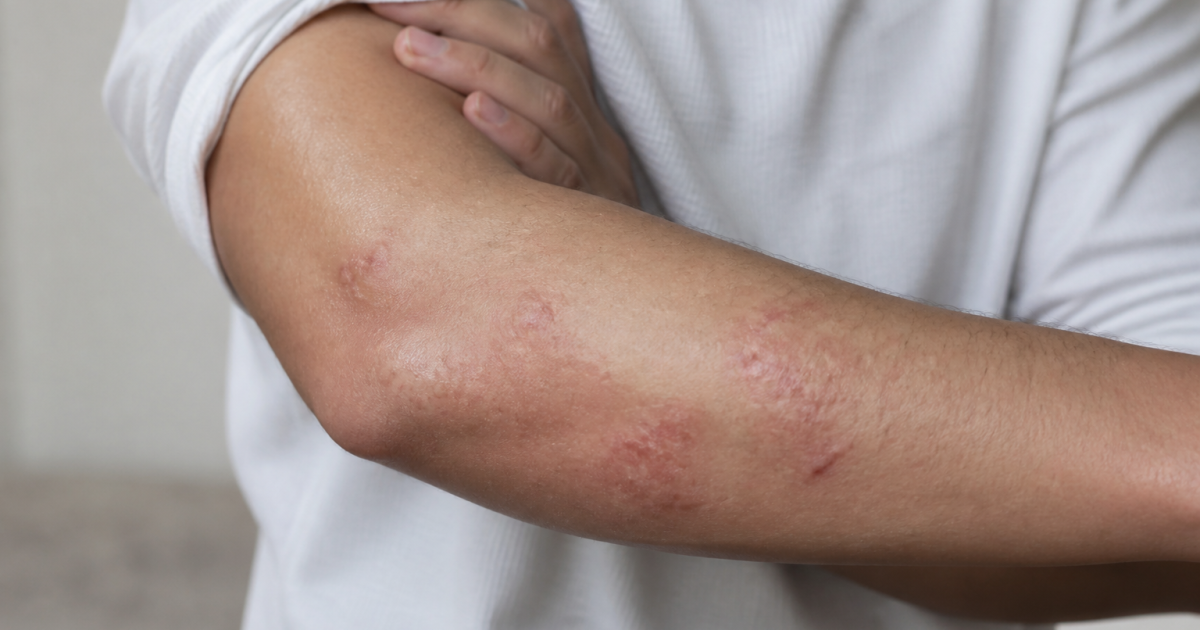 Peau irritee avec plaques rouges et inflammation visible sur le bras