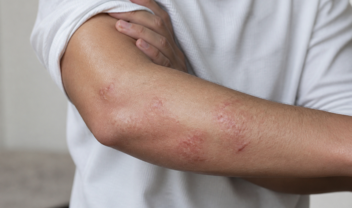 Peau irritee avec plaques rouges et inflammation visible sur le bras