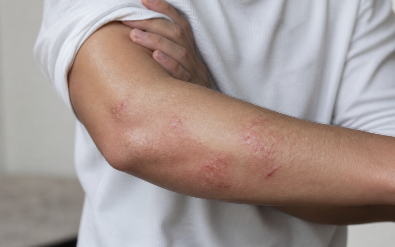 Peau irritee avec plaques rouges et inflammation visible sur le bras