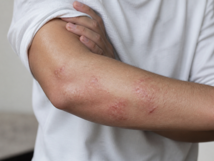 Peau irritee avec plaques rouges et inflammation visible sur le bras